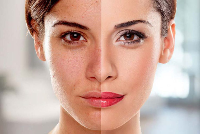 Skin Whitening Treatment Cost