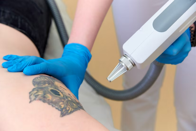 Tattoo Removal Treatment in Delhi