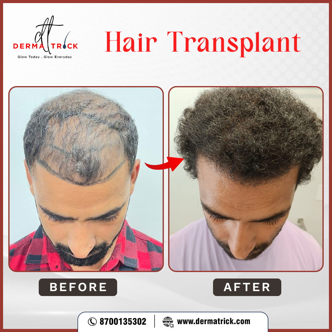 Hair Transplant In Delhi